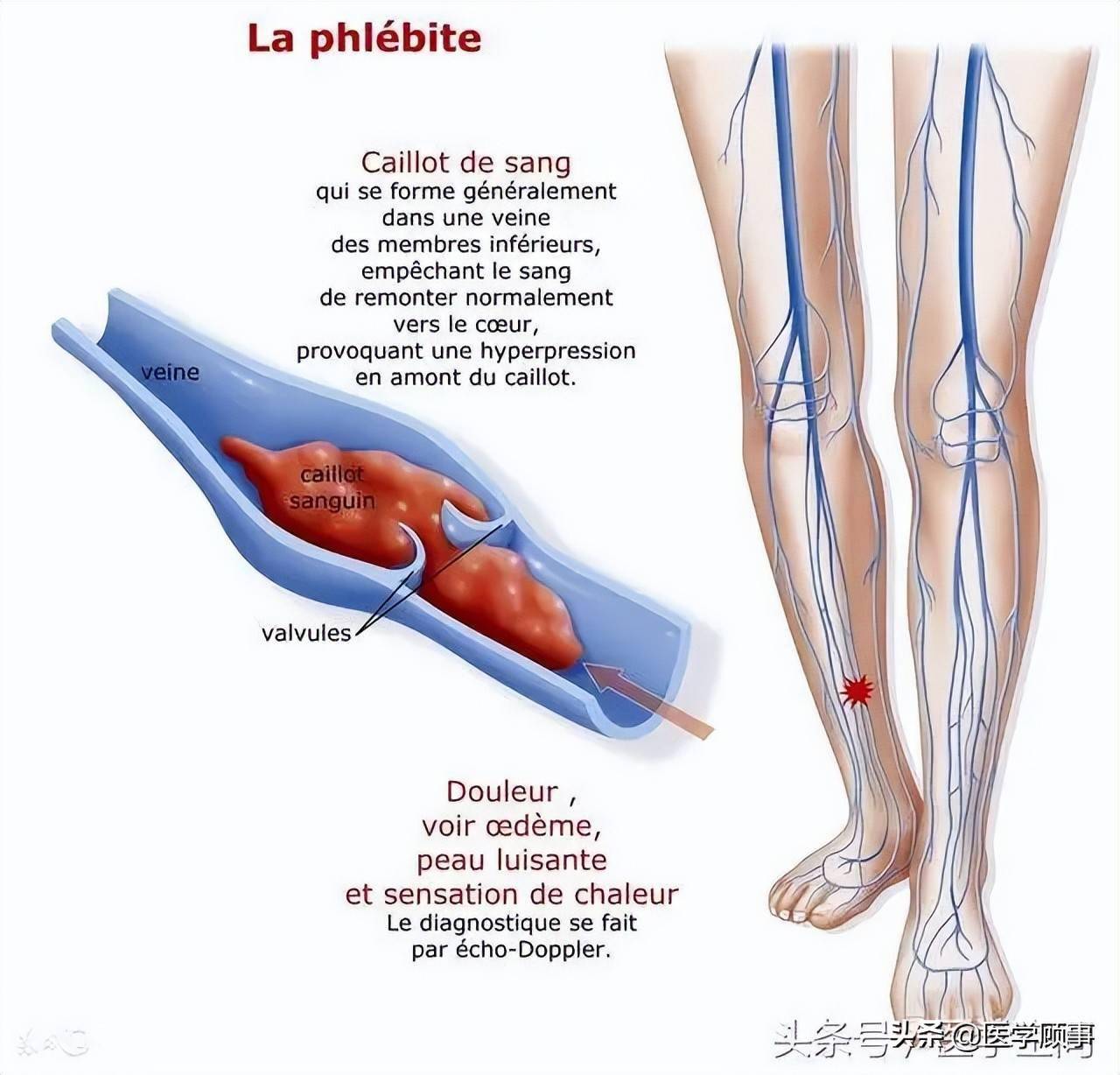 腿部血栓怎么办图片