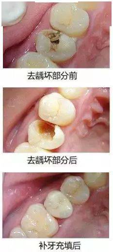 浅龋、中龋补牙就可以了,深龋牙髓炎要怎么办?_搜狐网