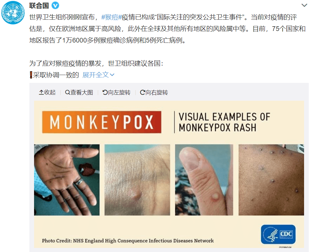 "双倍痛苦,几乎不能下床"_美国一男子同时感染新冠