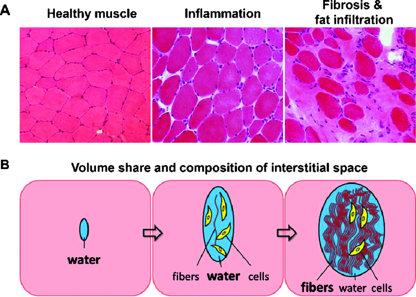 肌肉损伤与成纤维细胞
