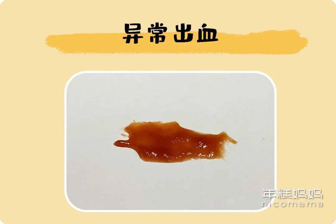 分泌物豆腐渣样图片