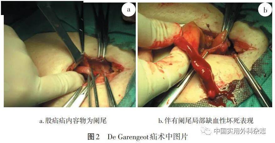 論著超聲引導下經petit三角區腹橫肌平面阻滯技術用於成人嵌頓性腹股