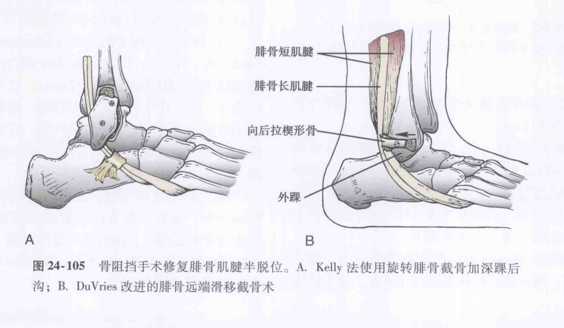 腓骨肌腱脱位不要再误诊为外踝扭伤了