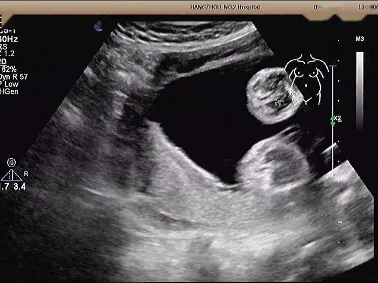 一文带你了解典型的副胎盘_子宫_超声_血管