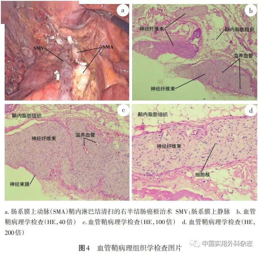 4 淋巴结清扫内侧界与神经保护右半结肠癌d3根治术淋巴结清扫内侧界