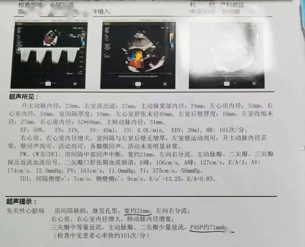 先心病(房间隔缺损),在市二院产科经子宫动脉临时封堵术,行剖宫产,术