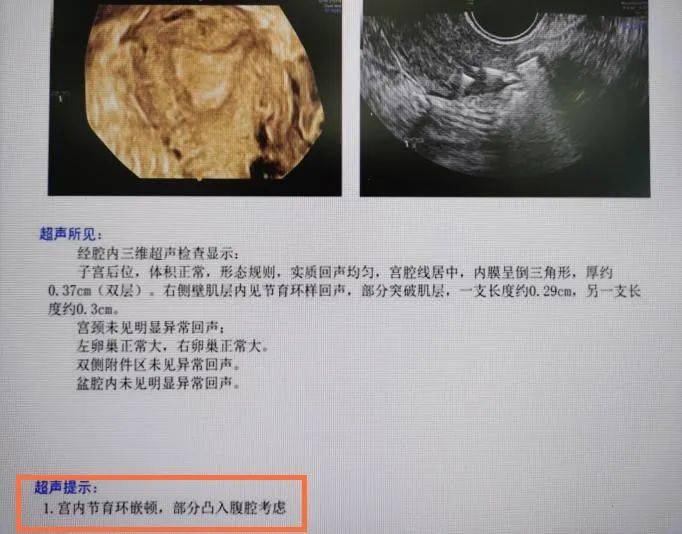 宫外孕手术单子图片图片