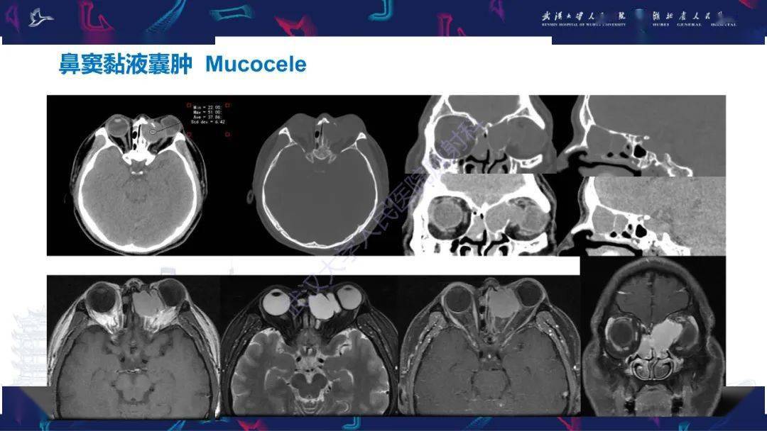 颌面部骨化性纤维瘤影像诊断