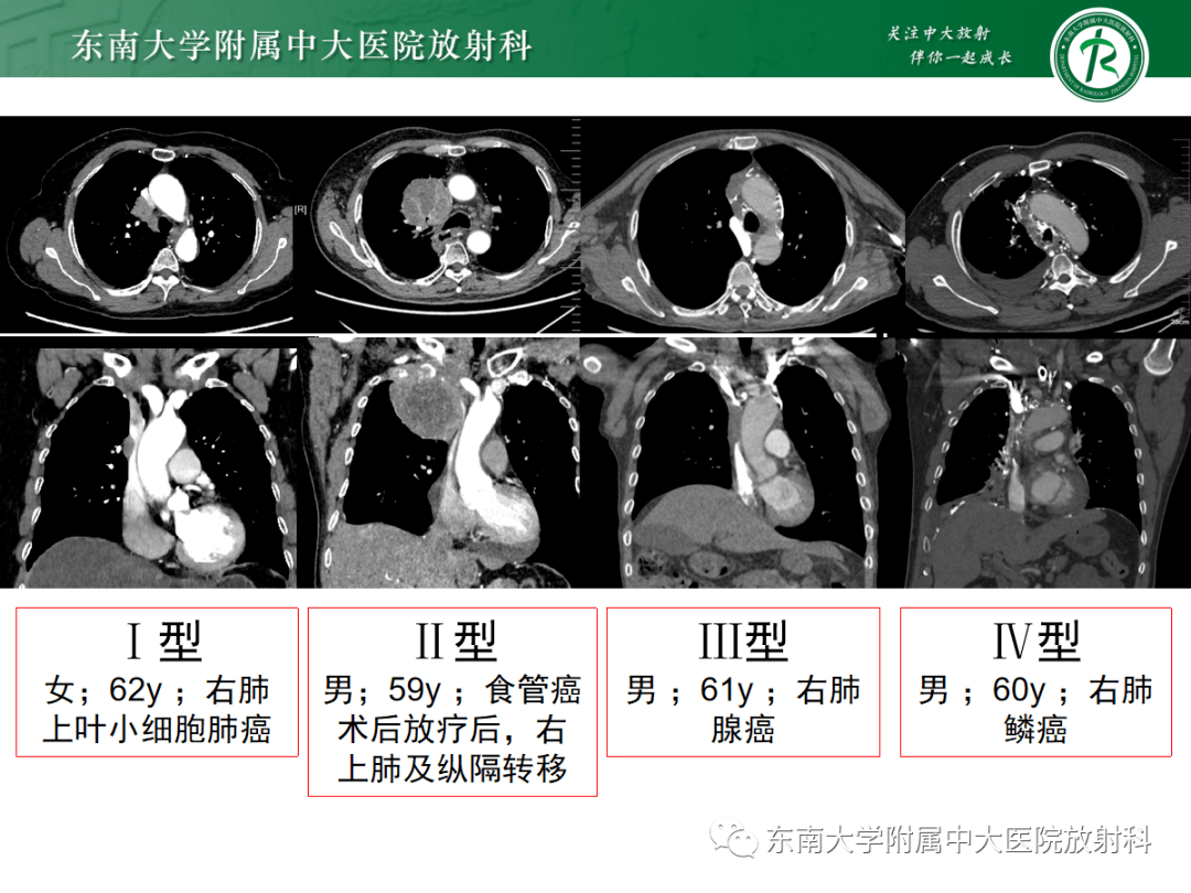 上腔静脉综合征mdct表现