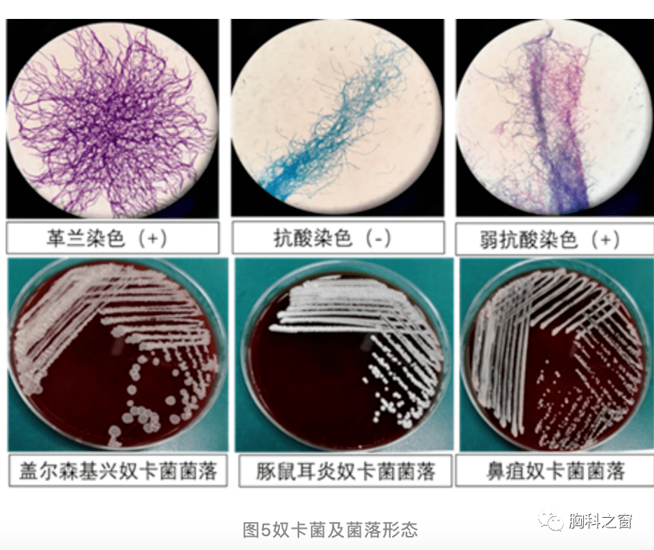 多造成肺型,播散型诺卡菌病,且多见于免疫缺陷,酒精中毒和某些肺部