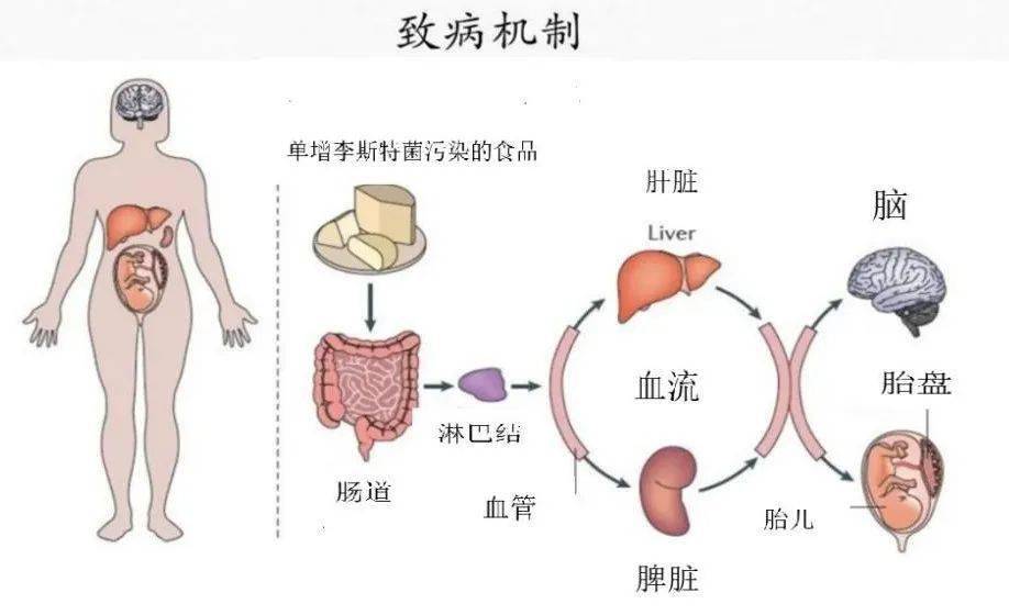 世界粮农组织/世界卫生组织风险评估报告中指出,感染单增李斯特菌引起