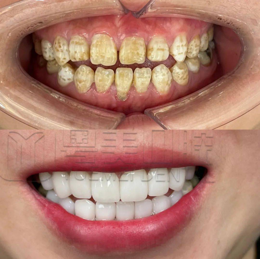 每个石湾人都可以是嘴强王者暑期牙齿矫正低至4800元