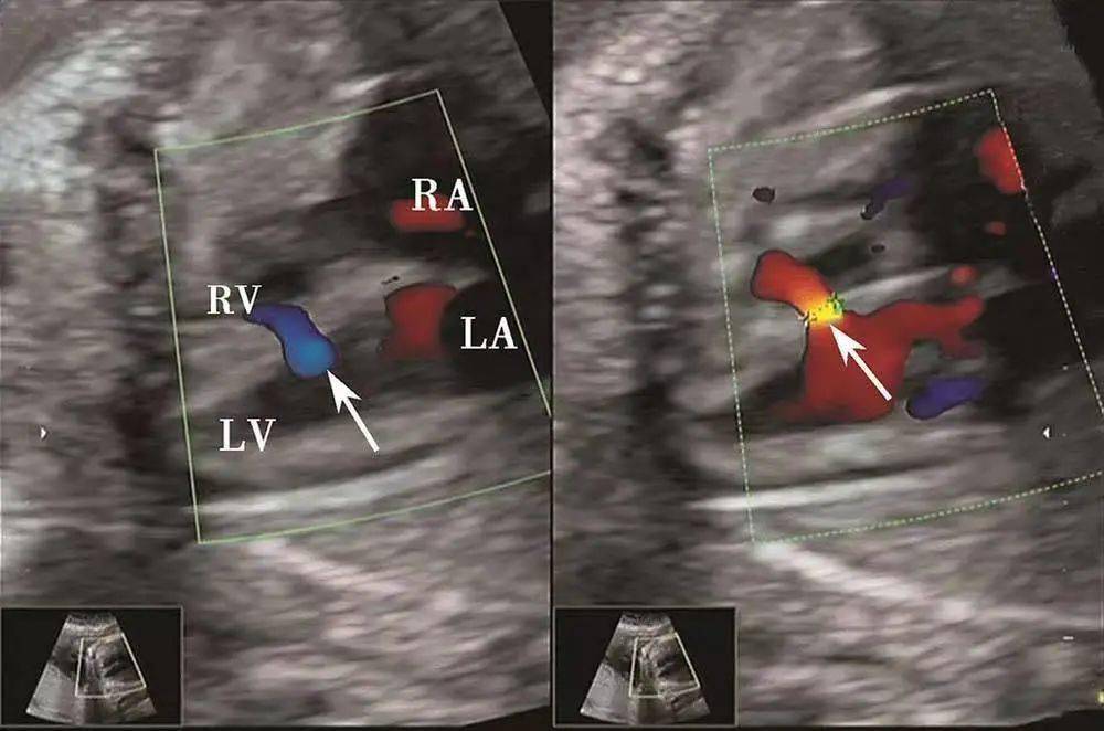 室间隔缺损超声图解图片