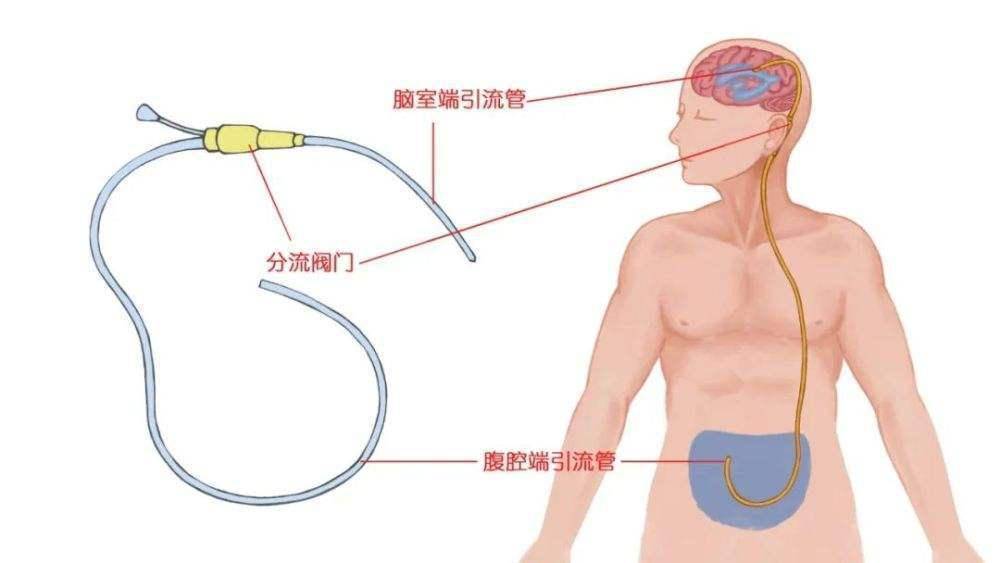 你以为的老年痴呆很可能只是“脑子进水”——常压性脑积水