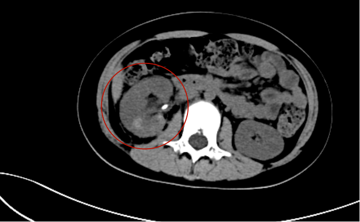 【"星"技术】孩童十几米高处坠落摔破肾脏,我院多学科救治挽回濒临