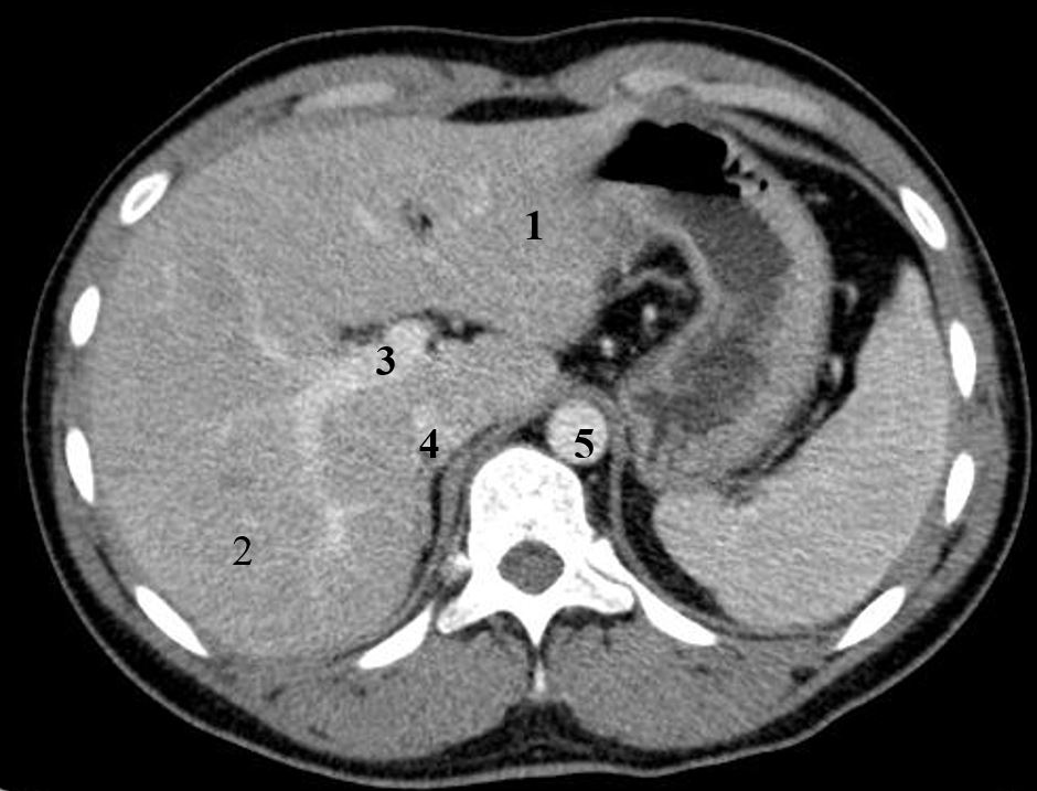 結合解剖看腹部ct,輕鬆掌握肝臟讀片!_靜脈_水平_臟器