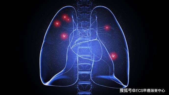 肺癌ct诊断报告图片图片