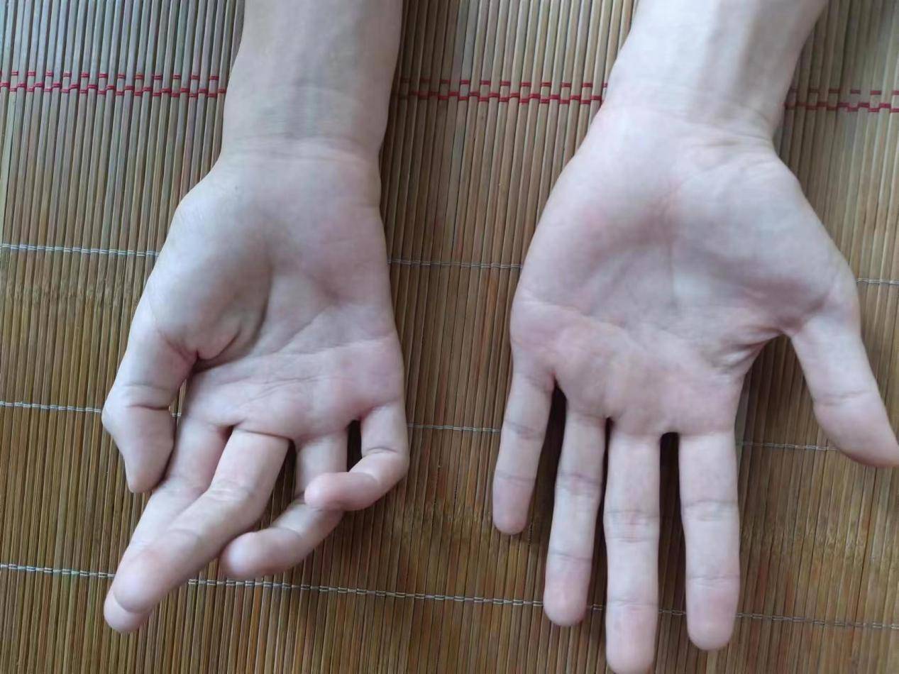 Muscle Wasting Left Hand: Atrophic flattening most ... | GrepMed