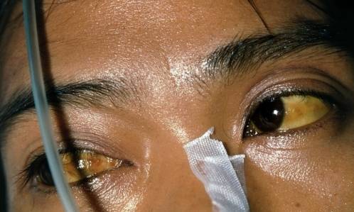 加速色素的沉淀,从而会导致面部发黄,眼睛出现黄疸眼睛模糊等症状