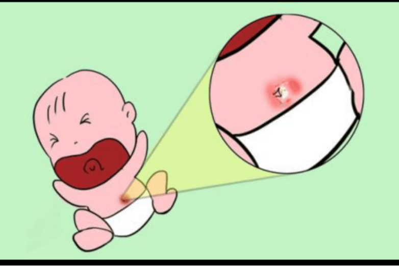 新生儿一侧乳房有米粒图片