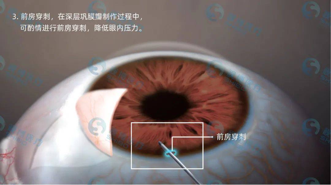 图解:微导管引导的 360 度小梁切开术(mat)