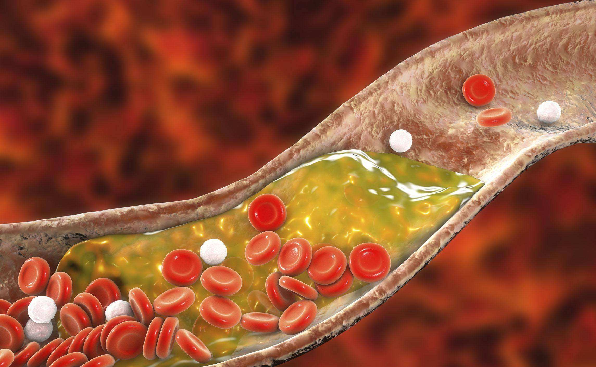 刘长城医生:血管里面有哪些脏东西呢?_大量的_脂肪_人群