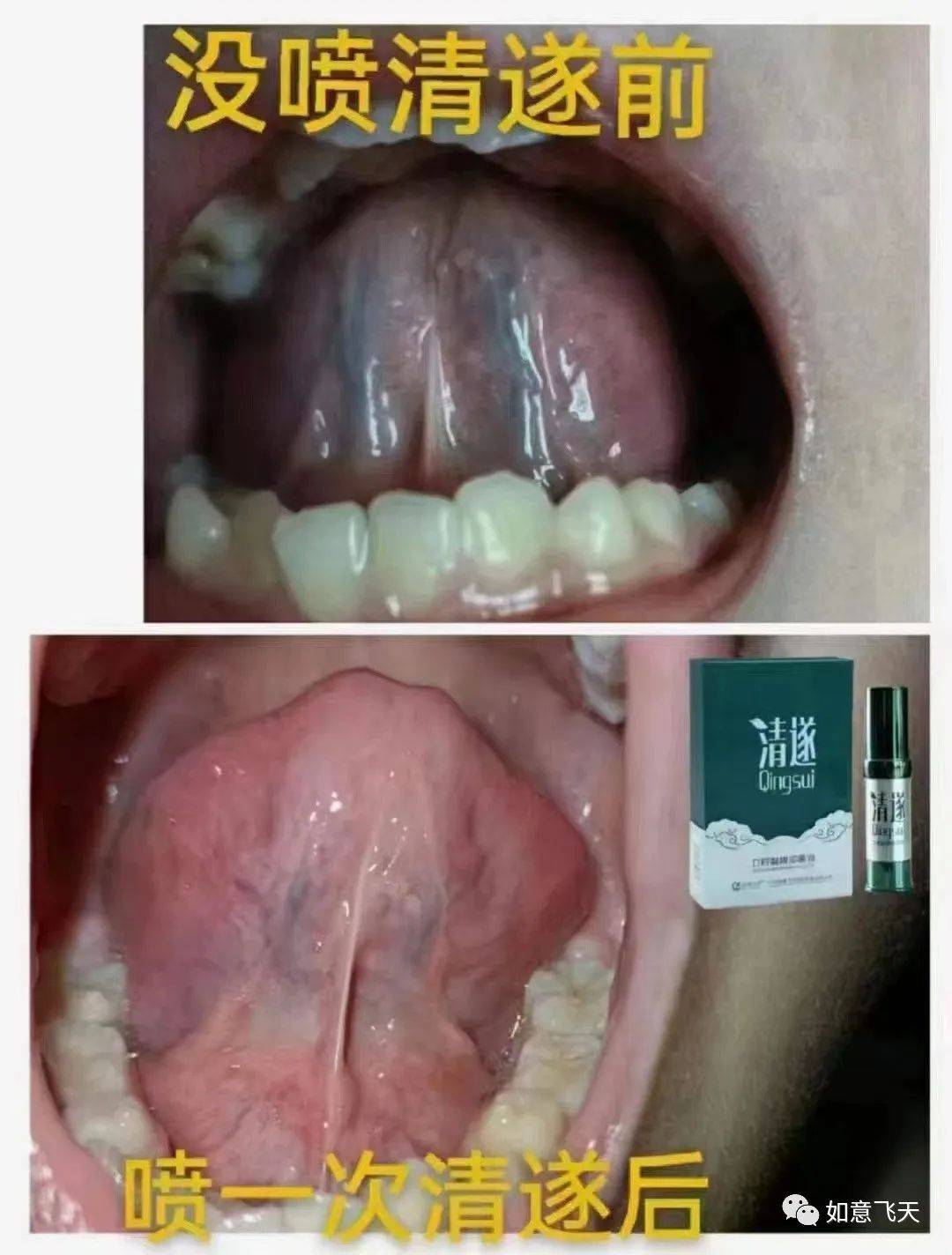 舌下取血栓 功效图片