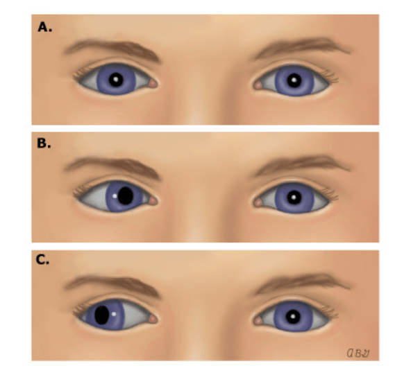 这种有重影的状态就是隐斜视,隐斜视分为内隐斜和外隐斜.
