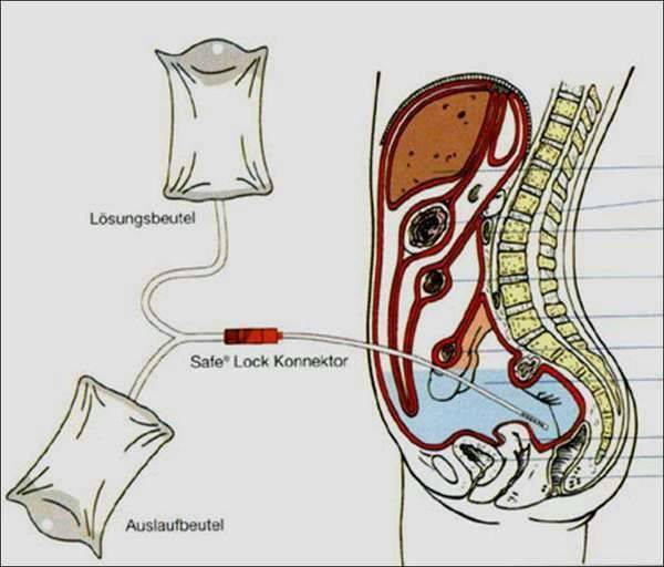 腹腔引流管健康宣教,我们该和患者聊点什么?