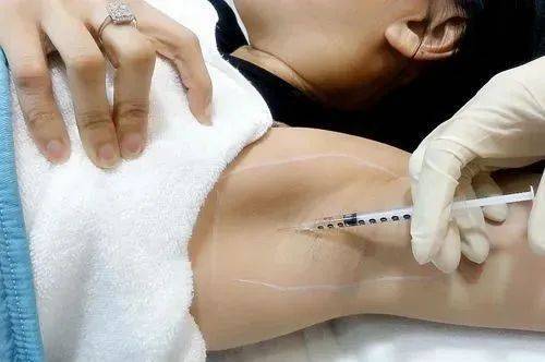 这两种方式都可以很大程度上的减轻腋臭,像是打肉毒素的话一年是打