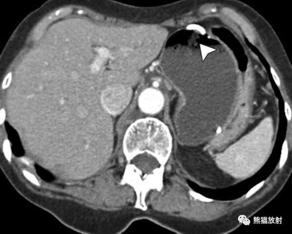 67急性胃疾病ct表现