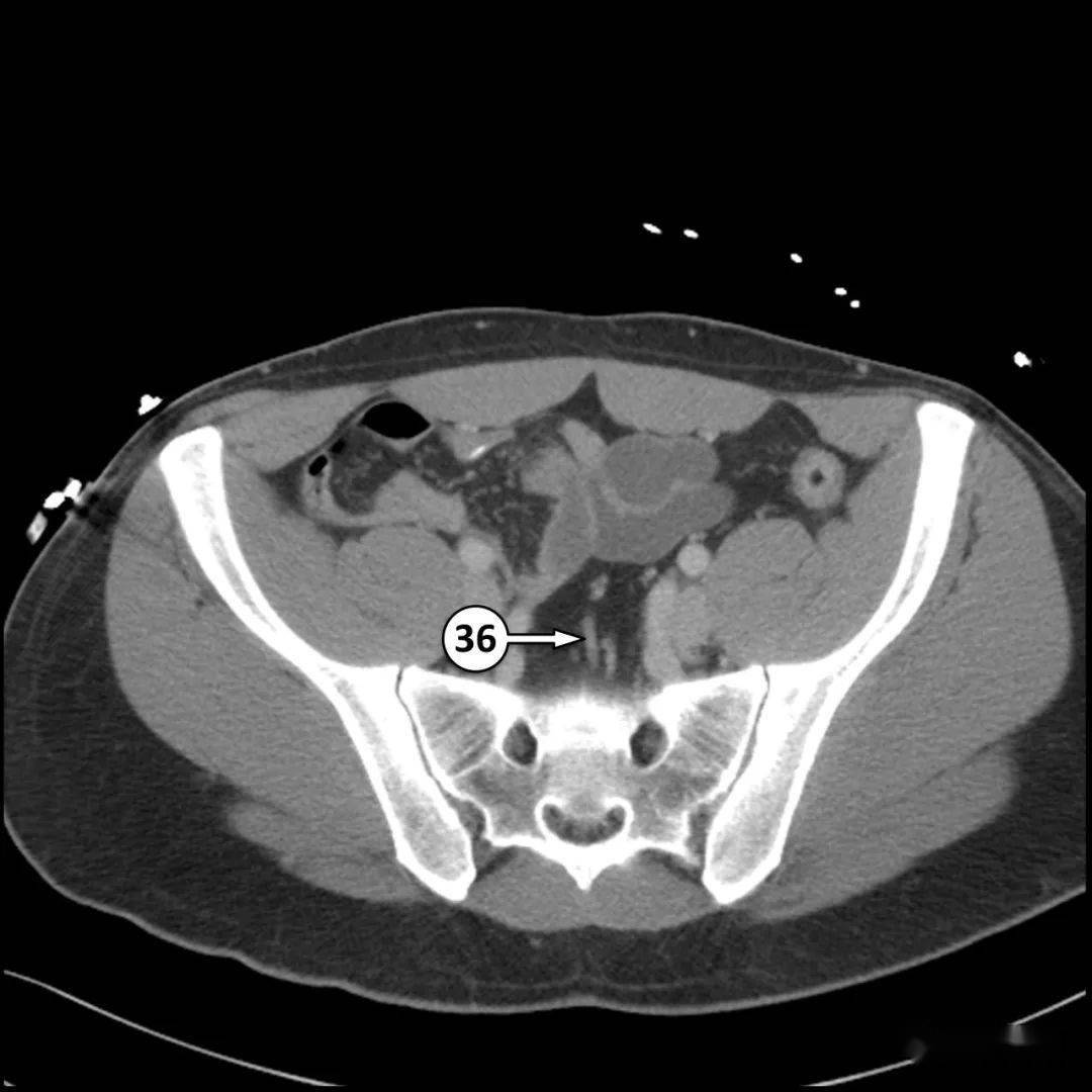 外斜肌27.盲肠26.竖脊肌群25.降结肠24.右髂总静脉23.内斜肌22.