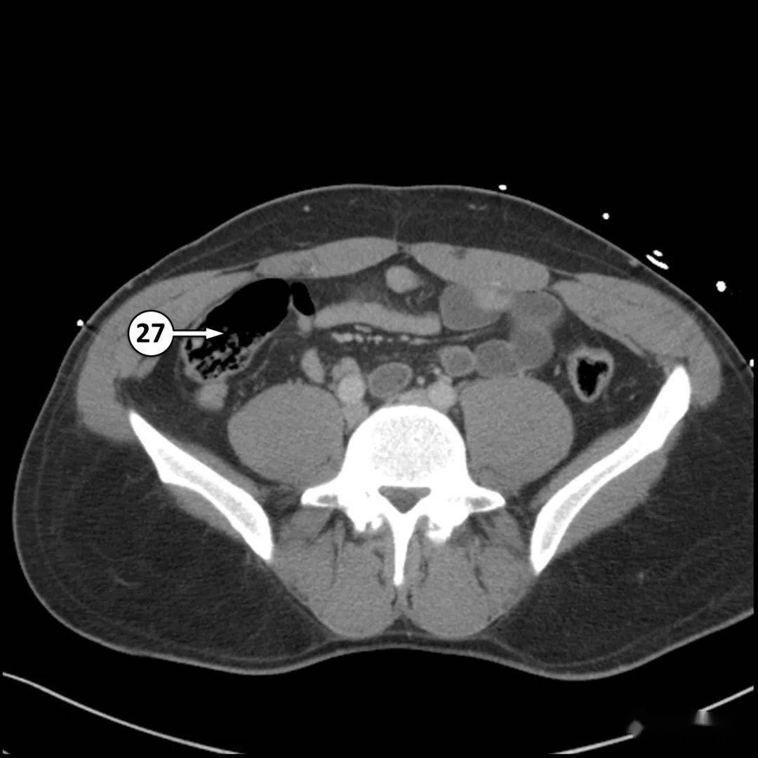 5分钟看完这篇,学会全腹ct解剖_动脉_静脉_血管