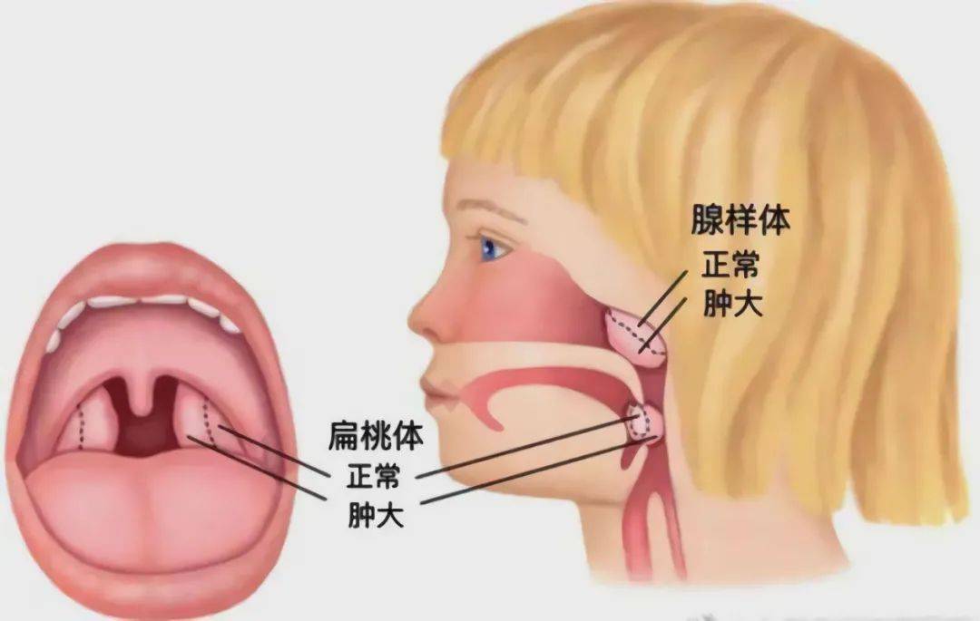 腺样体肥大位置图片