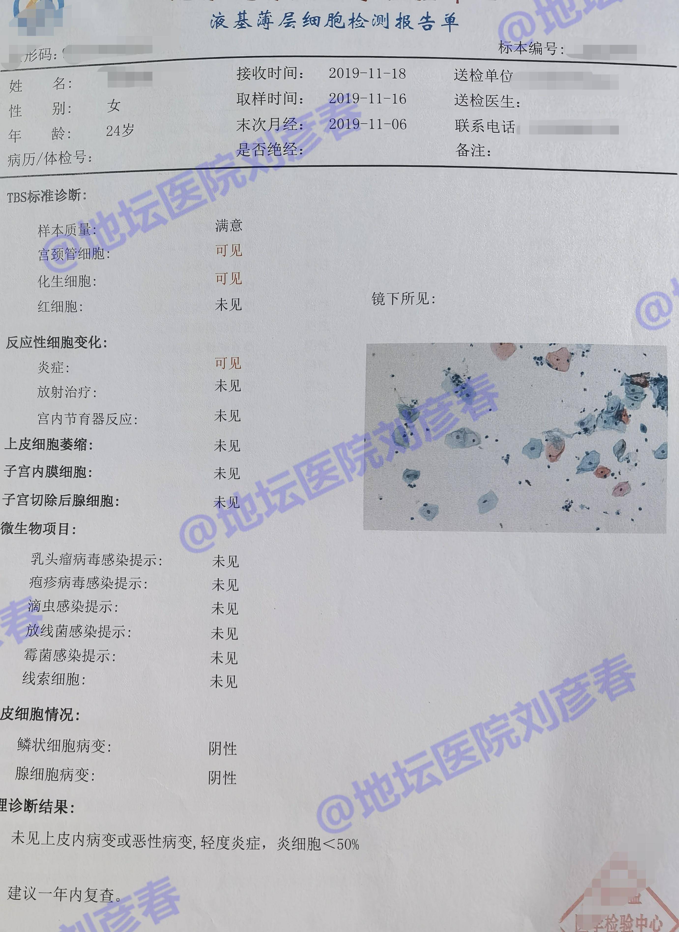 HPV感染异常分泌物图片图片