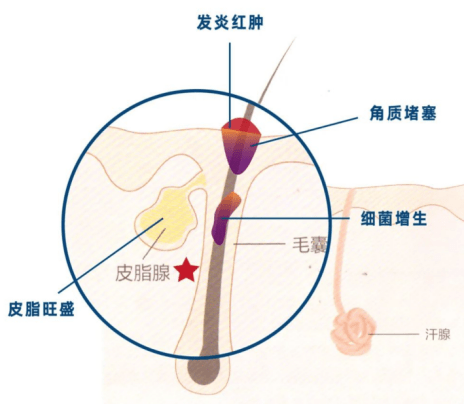 抗痘神器哪款好？Jan Marini六酸面霜不愧是油痘肌救星！