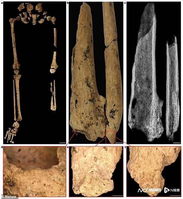 世界最早截肢术：印尼婆罗洲3.1万年前的年轻人切除了左脚插图2