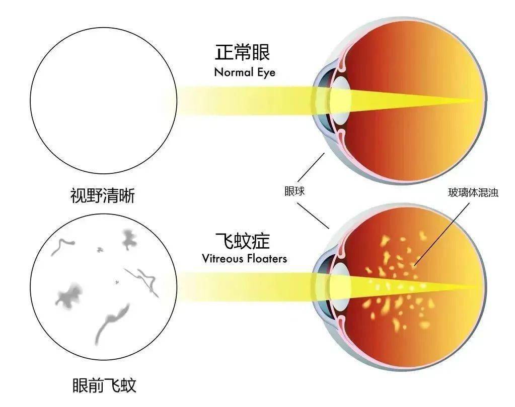 投影在视网膜上,就形成了飞蚊症的感觉,这又称为玻璃体混浊