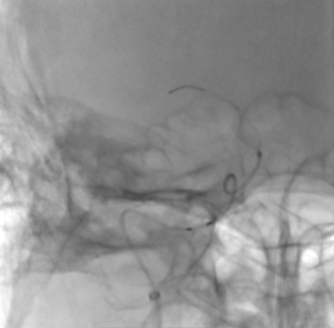 首都医科大学宣武医院成功完成聚辉医疗JTube血流导向密网支架全国首批临床入组_造影_mm_JTube
