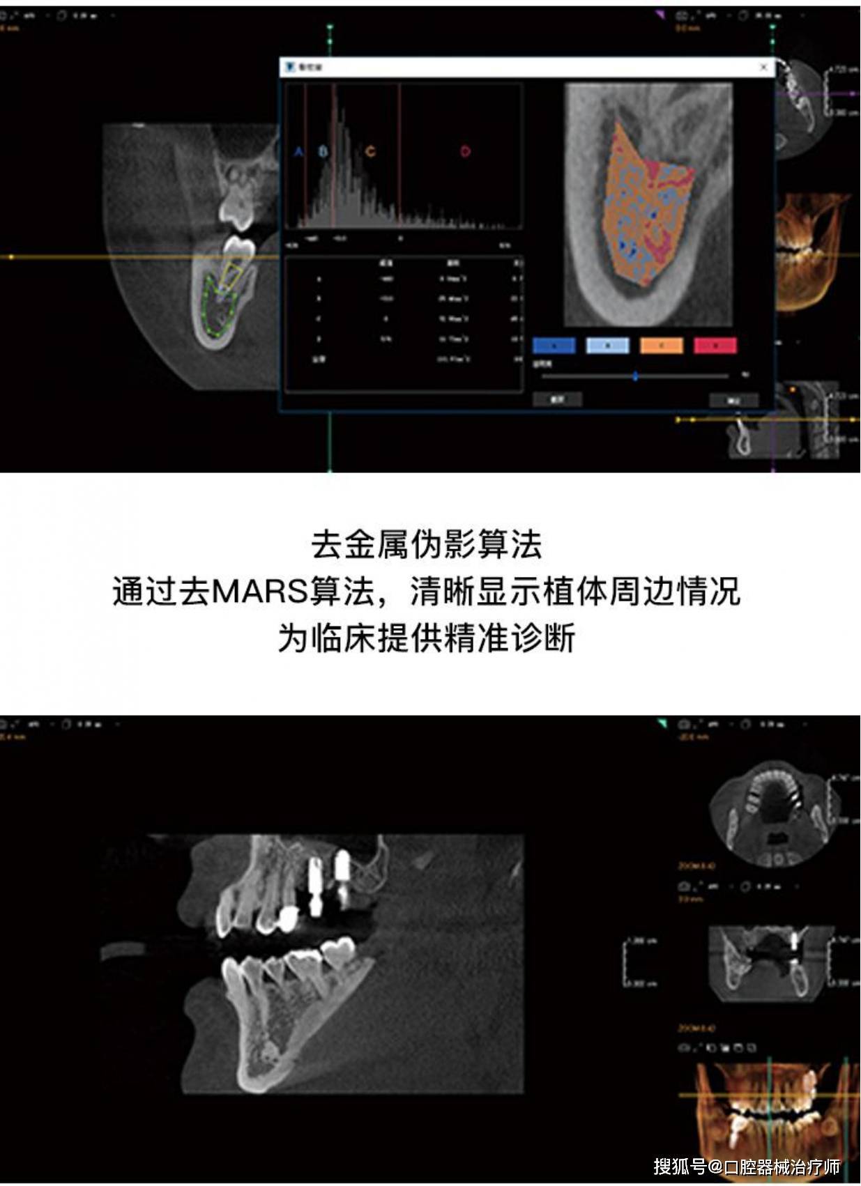 深圳菲森cbct,中大视野,高质量成像_解剖_临床_种植