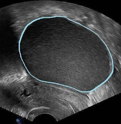 b超如果这么描述,卵巢囊肿就可能是恶性的!