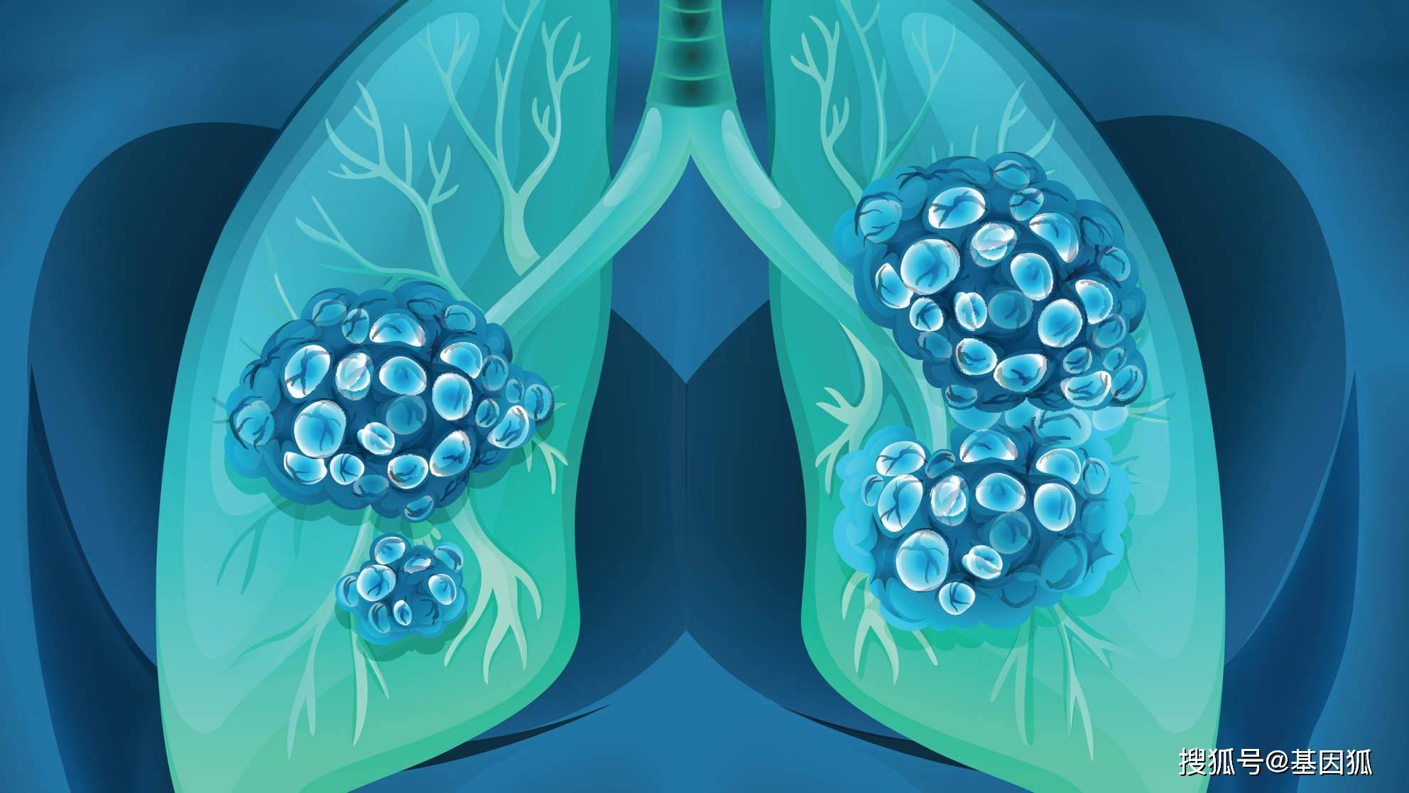 爱肺计划丨一图教你读懂肺癌高危人群免费筛查那些事儿-搜狐