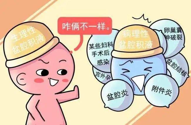"盆腔积液"到底是怎么回事?(下)_炎症_月经_细菌