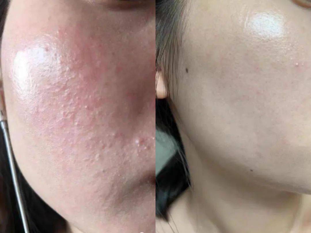 激素脸流黄水过敏怎么办?_皮肤_症状_护肤品