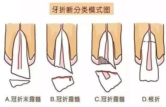 常见的牙齿外伤包括:牙齿松动,牙齿折断,牙齿脱出.