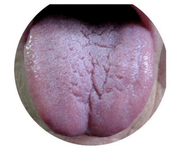 身体哪里出现了问题?一文教你看懂裂纹舌!_艾灸_情况_气血