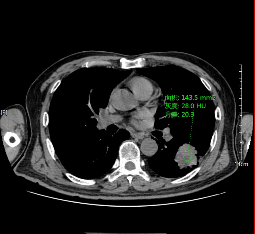肺癌ct图片图解片子图片