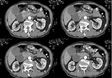 胰腺癌的ct诊断书图片图片