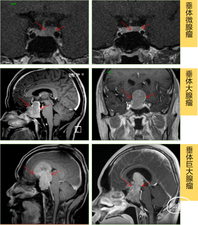 垂体增强磁共振检查(mri)是脑垂体瘤最重要的检查手段之一(mri可见