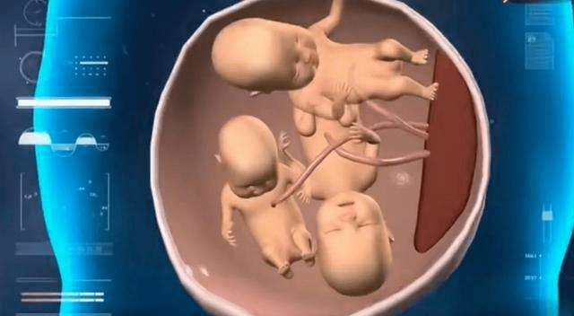 顺德一34岁产妇成功顺产单卵三胞胎